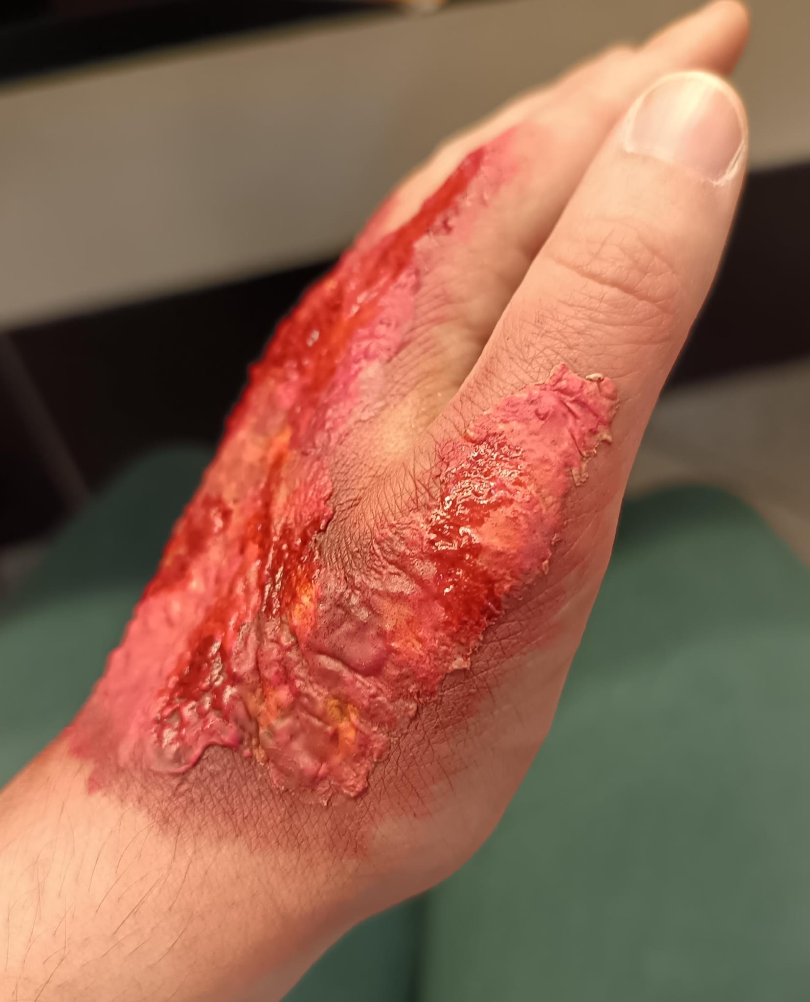 Trucco SFX - Effetto Bruciatura